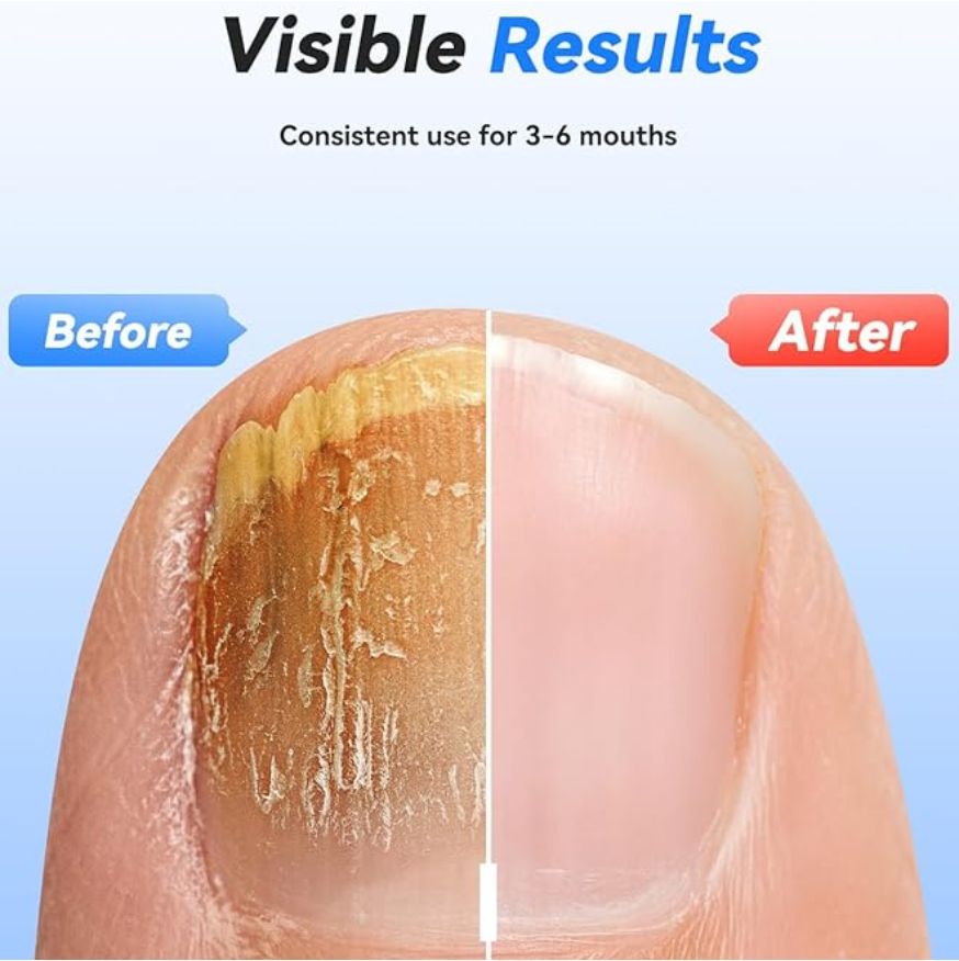 Nail Light Pro 2.0 - Eliminates fungus and whitens nails - TheWellnessClinicUK